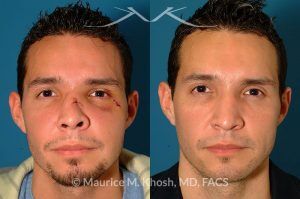 Photo of a patient before and after a procedure. Nose Fracture - before and after results.