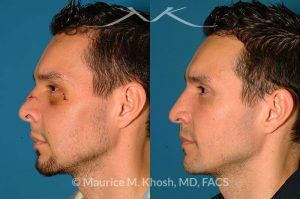 Photo of a patient before and after a procedure. Nose Fracture - before and after results.