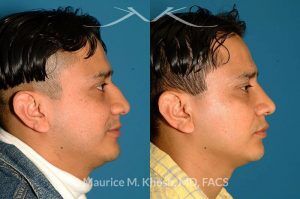 Photo of a patient before and after a procedure. Nose Fracture - before and after results.
