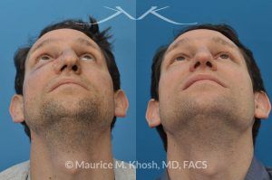 Photo of a patient before and after a procedure. Nose Fracture - before and after results.