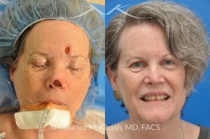 Photo of a patient before and after a procedure. Moh's skin cancer reconstruction - before and after photos.