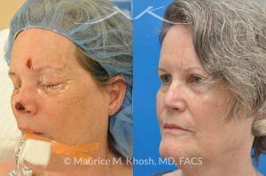 Photo of a patient before and after a procedure. Mohs reconstruction of forehead - before and after results.