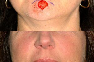 Photo of a patient before and after a procedure. Chin repair utilizing the O T advancement technique - before and after photos.