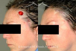 Photo of a patient before and after a procedure. Repair of lateral forehead defect - before and after photos.