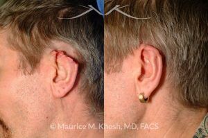 Photo of a patient before and after a procedure. Skin flap form posterior aspect of ear to repair large rim defect - before and after results.