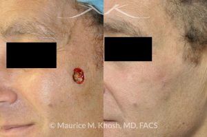 Photo of a patient before and after a procedure. Medium sized Mohs defect of cheek repaired with local flap - before and after photos.