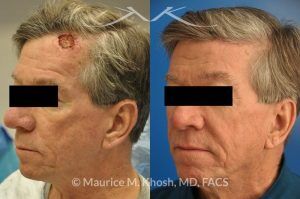 Photo of a patient before and after a procedure. Repair of forehead basal cell skin cancer defect after Mohs excision - before and after results.