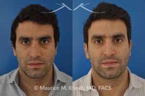 Photo of a patient before and after a procedure. Closed reduction of nose fracture, re-setting a proken nose as an office procedure - before and after results.