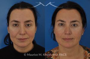 Photo of a patient before and after a procedure. FaceTite and Morpheus Treatment - before and after photo.