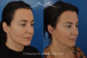 Photo of a patient before and after a procedure. FaceTite and Morpheus Treatment - before and after photo.