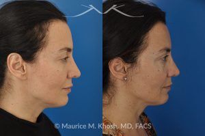 Photo of a patient before and after a procedure. FaceTite and Morpheus Treatment - before and after photo.