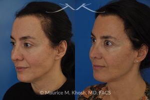 Photo of a patient before and after a procedure. FaceTite and Morpheus Treatment - before and after photo.
