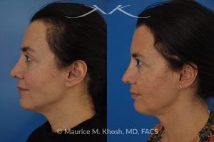Photo of a patient before and after a procedure. FaceTite and Morpheus Treatment - before and after photo.