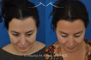 Photo of a patient before and after a procedure. FaceTite and Morpheus Treatment - before and after photo.