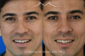 Photo of a patient before and after a procedure. Liquid rhinoplasty - This delightful patient disliked the nasal hump and droopy nasal tip. He was not ready for a surgical rhinoplasty. We performed liquid rhinoplasty in New York to elevate his nasal tip and straighten the nasal hump. Note that the nose tip does not droop even when he smiles. 