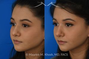 Photo of a patient before and after a procedure. Female patient before and after Liquid rhinoplasty - Liquid rhinoplasty in NYC for subtle improvement of the nasal tip and the bridge of the nose using facial fillers. Precise placement of minimal amounts of facial filler into the bridge of the nose and the nasal tip allowed our delightful patient to achieve a smooth nasal profile and a more proportioned and slightly elevated nasal tip. 
