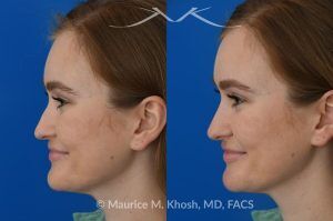 Photo of a patient before and after a procedure. Liquid rhinoplasty - This 25 year old was interested in non-surgical rhinoplasty in our New York office. She wanted to eliminate the hump in the bridge of her nose, and rotate the nasal tip. These before and after pictures demonstrate the dramatic effect of the treatment. 