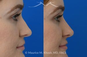 Photo of a patient before and after a procedure. Liquid rhinoplasty - This 25 year old was interested in non-surgical rhinoplasty in our New York office. She wanted to eliminate the hump in the bridge of her nose, and rotate the nasal tip. These before and after pictures demonstrate the dramatic effect of the treatment. 