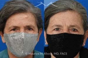 Photo of a patient before and after a procedure. Forehead Osteoma Removal - before-and-after composite photo.