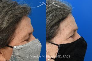 Photo of a patient before and after a procedure. Forehead Osteoma Removal - before-and-after composite photo.
