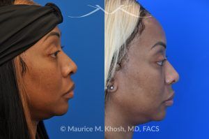 Photo of a patient before and after a procedure. Rhinoplasty to narrow nostrils and bridge of nose, neck liposuction - before and after results.