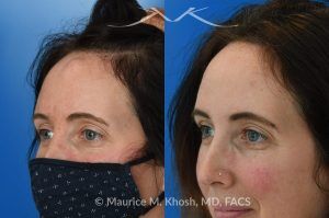 Photo of a patient before and after a procedure. Forehead Osteoma Removal Under Local Anesthesia - This 43 year old sought treatment for forehead osteoma in our New York office. She had the osteoma present for 20 years. The osteoma removal was performed in the office under local anesthesia. 

