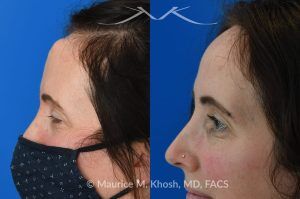 Photo of a patient before and after a procedure. Forehead Osteoma Removal Under Local Anesthesia - This 43 year old sought treatment for forehead osteoma in our New York office. She had the osteoma present for 20 years. The osteoma removal was performed in the office under local anesthesia. 

