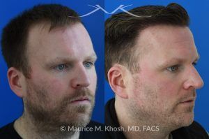 Photo of a patient before and after a procedure. FUE Hair Transplant for Receding Hairline - This 36 year old man requested hair restoration for receding hairline.  A follicular extraction transplant (FUE) procedure allowed transplantation of 1800 follicles from the back of the head to the frontal and temporal region of the scalp. The photo shows his one year post transplant results. He is ecstatic with his results.