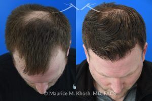 Photo of a patient before and after a procedure. FUE Hair Transplant for Receding Hairline - This 36 year old man requested hair restoration for receding hairline.  A follicular extraction transplant (FUE) procedure allowed transplantation of 1800 follicles from the back of the head to the frontal and temporal region of the scalp. The photo shows his one year post transplant results. He is ecstatic with his results.