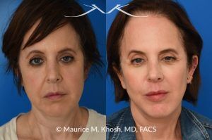 Photo of a patient before and after a procedure. Short-Flap Facelift with Buccal Fat Removal - This 54-year-old was unhappy with the 'heavy' and aged appearance of her lower face. A combination of short-flap facelift and buccal fat removal (performed under local anesthesia) was used to restore the  youthful and heart-shaped contour of the lower face.
