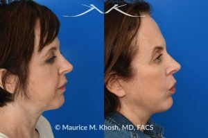 Photo of a patient before and after a procedure. Short-Flap Facelift with Buccal Fat Removal - This 54-year-old was unhappy with the 'heavy' and aged appearance of her lower face. A combination of short-flap facelift and buccal fat removal (performed under local anesthesia) was used to restore the  youthful and heart-shaped contour of the lower face.