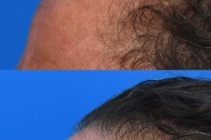 Photo of a patient before and after a procedure. Forehead Osteoma Removal with Concealed Hairline Incision - This gentleman had a large osteoma of the forehead which made him very self conscious. He always wore hats to hide his forehead. The excess bone was removed through a perfectly hidden incision in his hairline. 