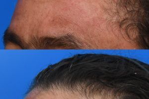 Photo of a patient before and after a procedure. Forehead Osteoma Removal with Concealed Hairline Incision - This gentleman had a large osteoma of the forehead which made him very self conscious. He always wore hats to hide his forehead. The excess bone was removed through a perfectly hidden incision in his hairline. 
