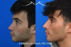 Photo of a patient before and after a procedure. Revision rhinoplasty for scooped appearing nose - This young patient has previously undergone rhinoplasty, which resulted in an over-resected nasal bridge with a 'scooped slope'. He wanted revision rhinoplasty to restore the natural height and contour to the bridge of his nose. He also wanted to reduce the nasal tip rotation. We used his septal cartilage and ear cartilage to restore the nose. He is ecstatic with his results. 