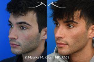 Photo of a patient before and after a procedure. Revision rhinoplasty for scooped appearing nose - This young patient has previously undergone rhinoplasty, which resulted in an over-resected nasal bridge with a 'scooped slope'. He wanted revision rhinoplasty to restore the natural height and contour to the bridge of his nose. He also wanted to reduce the nasal tip rotation. We used his septal cartilage and ear cartilage to restore the nose. He is ecstatic with his results. 