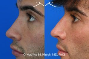 Photo of a patient before and after a procedure. Revision rhinoplasty for scooped appearing nose - This young patient has previously undergone rhinoplasty, which resulted in an over-resected nasal bridge with a 'scooped slope'. He wanted revision rhinoplasty to restore the natural height and contour to the bridge of his nose. He also wanted to reduce the nasal tip rotation. We used his septal cartilage and ear cartilage to restore the nose. He is ecstatic with his results. 