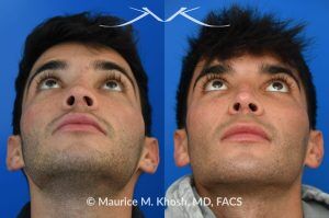 Photo of a patient before and after a procedure. Revision rhinoplasty for scooped appearing nose - This young patient has previously undergone rhinoplasty, which resulted in an over-resected nasal bridge with a 'scooped slope'. He wanted revision rhinoplasty to restore the natural height and contour to the bridge of his nose. He also wanted to reduce the nasal tip rotation. We used his septal cartilage and ear cartilage to restore the nose. He is ecstatic with his results. 
