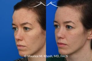 Photo of a patient before and after a procedure. Osteoma Removal via Hidden Hairline Incision - The bony hump in the right upper forehead (an osteoma) was successfully treated through a hairline incision with a perfectly hidden scar within the hairline.