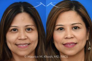Photo of a patient before and after a procedure. Central Forehead Osteoma Removal Under Local Anesthesia - Central forehead osteoma was removed through an invisible 1cm incision in the hairline. The osteoma removal was performed in the office under local anesthesia in our Manhattan office