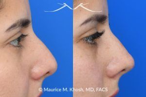 Photo of a patient before and after a procedure. Liquid rhinoplasty - Female patient before and after Liquid rhinoplasty.