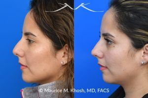 Photo of a patient before and after a procedure. Liquid rhinoplasty - Female patient before and after Liquid rhinoplasty.