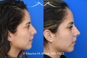 Photo of a patient before and after a procedure. Liquid rhinoplasty - Female patient before and after Liquid rhinoplasty.