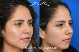 Photo of a patient before and after a procedure. Liquid rhinoplasty - Female patient before and after Liquid rhinoplasty.