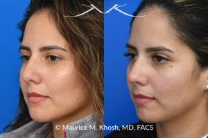 Photo of a patient before and after a procedure. Liquid rhinoplasty - Female patient before and after Liquid rhinoplasty.
