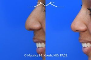 Photo of a patient before and after a procedure. Liquid rhinoplasty - photo before and after procedure.