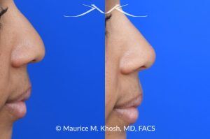 Photo of a patient before and after a procedure. Liquid rhinoplasty - photo before and after procedure.