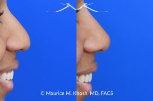 Photo of a patient before and after a procedure. Liquid rhinoplasty - photo before and after procedure.