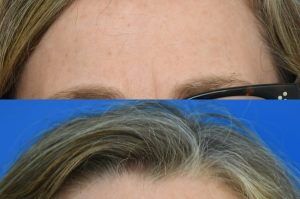 Photo of a patient before and after a procedure. Right Upper Forehead Osteoma - before-and-after composite photo.