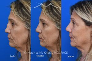 Photo of a patient before and after a procedure. Saddle Nose Reconstruction Using Autologous Rib Cartilage - Saddle nose nasal deformity due to large septum perforation and loss of bridge and tip support. The deformity was reconstructed utilizing the patient's own rib cartilage which was carved to recreate a natural nose that looks better and functions better.