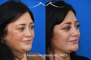 Photo of a patient before and after a procedure. Revision rhinoplasty utilizing rib cartilage - Revision rhinoplasty utilizing the patient's own rib cartilage to address collapsing cartilaginous nasal bridge, obstructed breathing, and nasal tip asymmetry. Surgical maneuvers including bilateral spreader grafts, alar strut grafts, columellar strut graft,and a shield graft were used to enhance nasal breathing and aesthetics. The post operative pictures were taken two months after surgery. Further improvement is expected upto eighteen months post op.